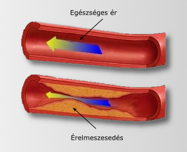 Az érelmeszesedés tünetei